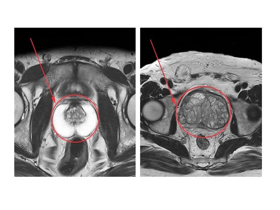 Prostata osasuntsu (ezkerrean) eta hanturatuta (eskuinean) konparaketa MRI irudietan
